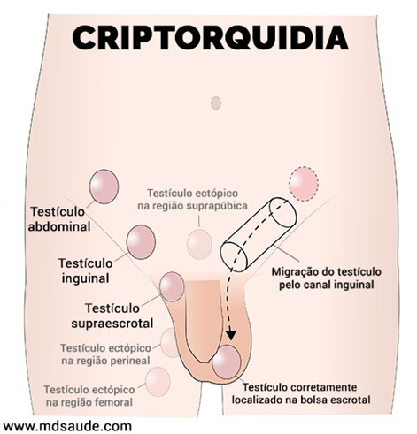 criptorquidia