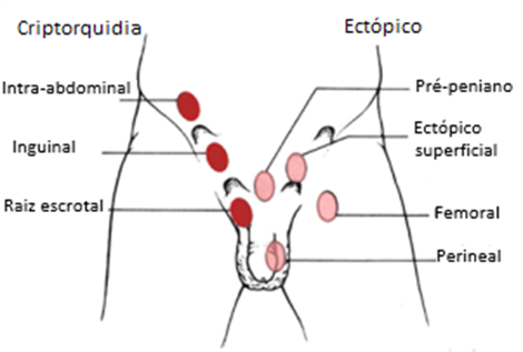 Criptorquidia