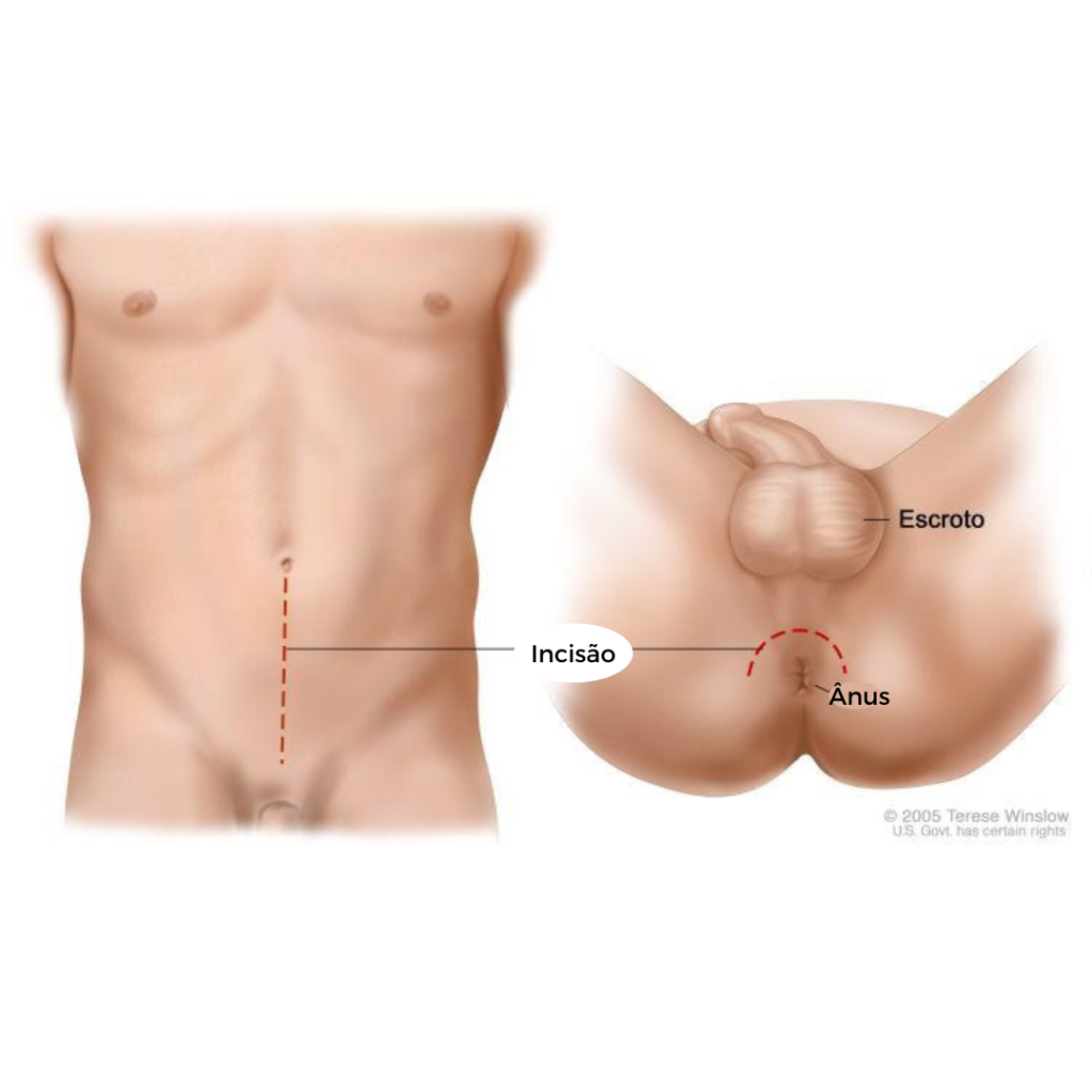 incisão aberta - prostata