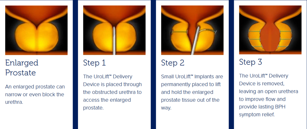 mist - urolift